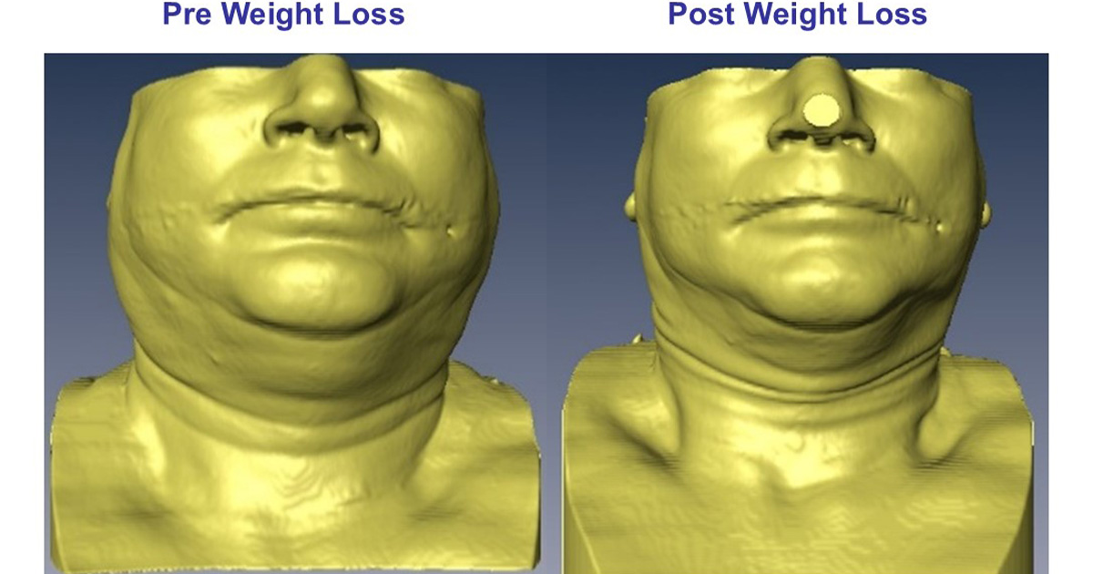 OSA treatment may reduce diabetes and heart disease